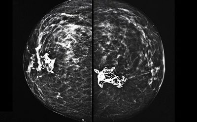 3D mammograms increasing in popularity for breast cancer screening in the USA