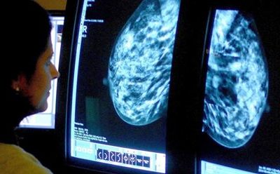 3D Mammography could transform breast cancer screening and save thousands from unnecessary biopsies