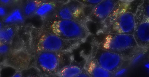 FDA approves Atezolizumab for Triple-Negative Breast Cancer